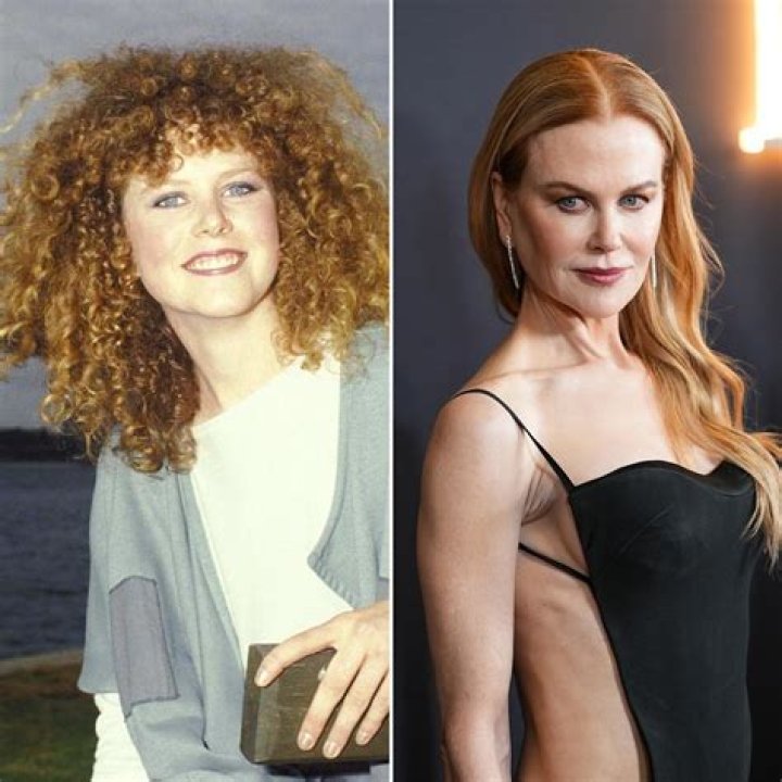 Nicole Kidman's Transformation: Before And After Surgery