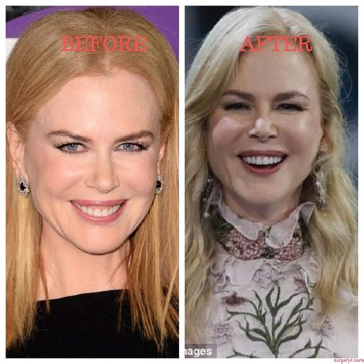 The Truth Revealed: Has Nicole Kidman Undergone Plastic Surgery?