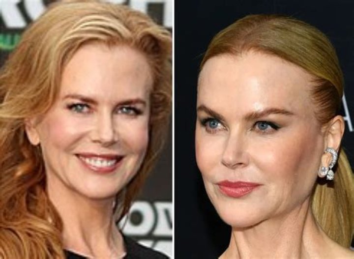 The Ultimate Guide To Nicole Kidman's Facelift: Before And After Comparisons