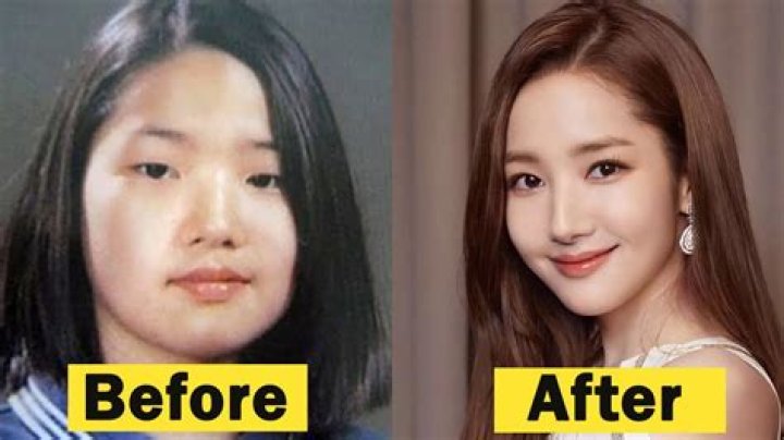 Unveiling The Truth Behind Kim Ji Won Plastic Surgery